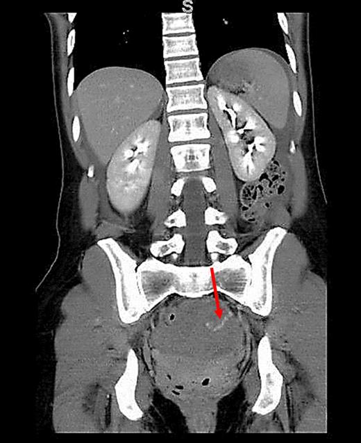 CT (coronal view) of the abdomen and pelvis showing extravasation of contrast material into the left pelvis (red arrow).