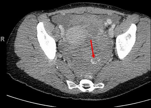 CT (axial view) of the pelvis showing extravasation of contrast material into the left pelvis (red arrow).