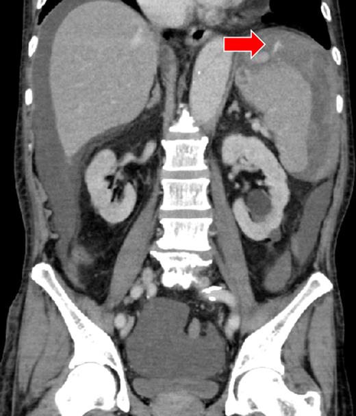 There was a massive hematoma in the peritoneum surrounding the spleen and the liver, and extending into the paracolic gutter and the pelvic cavity. The capsule of the spleen was disrupted, and active arterial extravasation can be seen around the spleen (arrow).