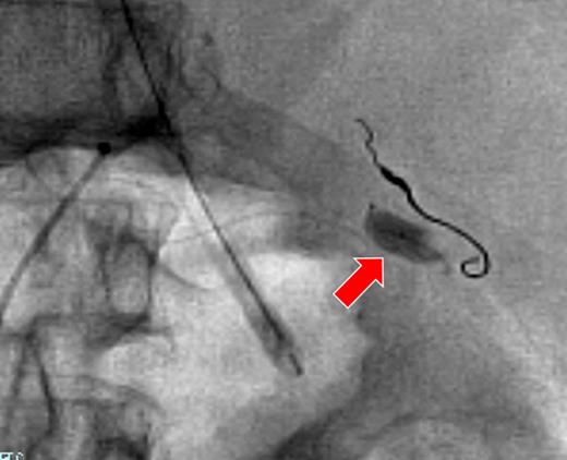 The right gastroepiploic artery with platinum coils after embolization. The microballoon catheter was placed in the splenic artery (arrow).