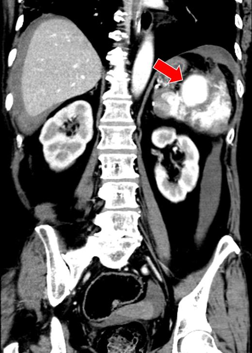 There was a massive hematoma surrounding the spleen and the liver. A giant splenic aneurysm (40 × 50 mm) and splenic laceration are seen (arrow).