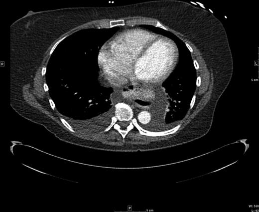 Axial CT view of the paraesophageal hernia and mediastinal fluid.
