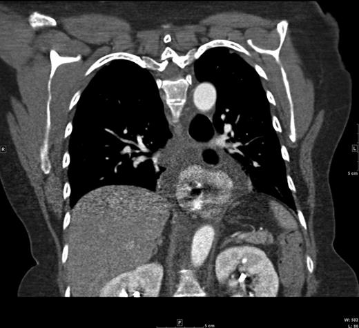 Coronal CT view of the paraesophageal hernia and mediastinal fluid.