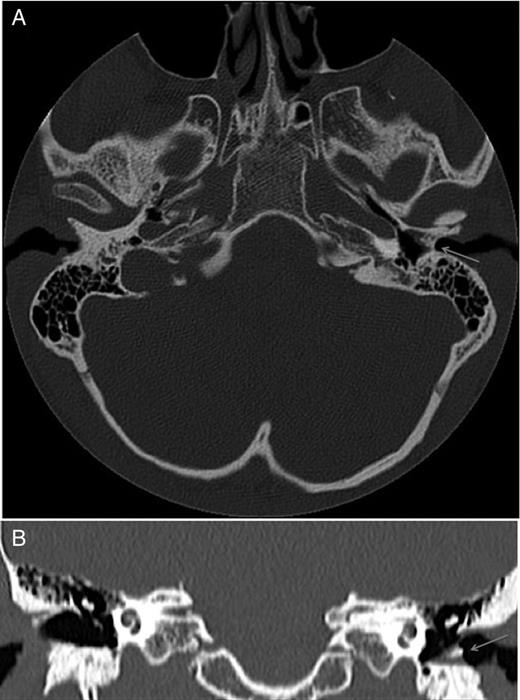 CT temporal bone axial (A) and coronal (B) slices, demonstrating a soft tissue thickening of the left medial external auditory canal containing dense calcification (arrow).