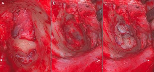 Intraoperative images showing the horizontal bony bar (A), view of an intact tympanic membrane post-drilling (B) and placement of a partial-thickness skin graft (C).