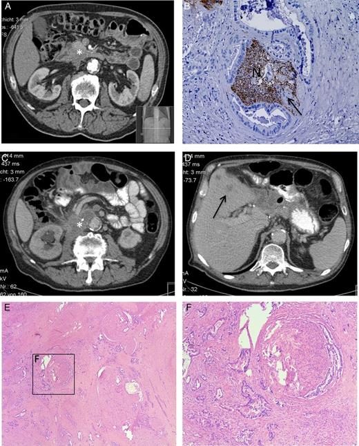 (A) Preoperative CT scan after the neoadjuvant chemotherapy shows the pancreatic head tumor (*). (B) Postoperative histopathological analysis shows severe NI of PCa cells (indicated by the arrow) in the nerve (N), staining: protein gene product 9.5 (PGP9.5), hematoxylin counter stain. (C and D) The CT scan shows the 7 months postoperative diagnosed local recurrence (*) and liver metastasis (→). (E and F) Postmortem histopathological analysis shows the invasion of pancreatic tumor cells in the extrapancreatic neural (here celiac) plexus.