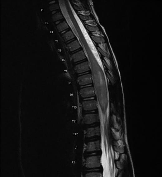 Sagittal MRI T2-weighted demonstrating an intramedullary mass spanning T6 to T11. The mass measures 7.8 × 1.4 × 1.5 cm and is the largest in diameter at the T8 level where it demonstrates considerable cerebrospinal fluid effacement. There is no associated syrinx. Post gadolinium contrast imaging (not shown) shows patchy enhancement, most evident in the inferior aspect of the lesion.