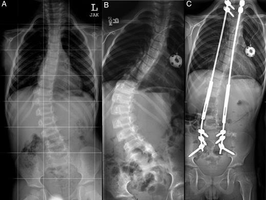 Anterior-posterior (AP) plain films of the spine at the time of diagnosis (A), after curve progression (B) and 1 year after growing rod insertion (C). Measured Cobb angles were 32 degrees (A), 64 degrees (B) and 22 degrees (C), respectively.