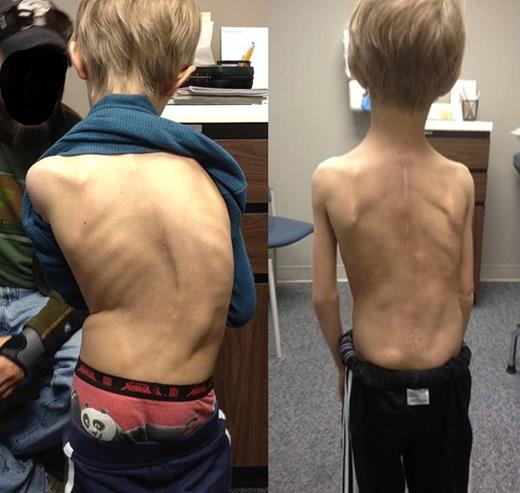 Clinical images prior to dual growing rod insertion (A) and 1 year after growing rod insertion (B).