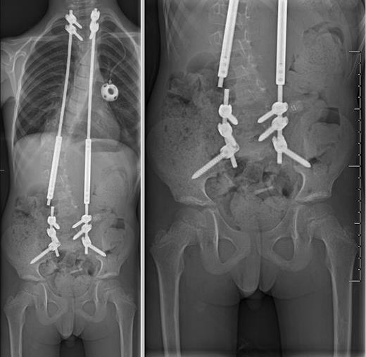 AP plain films demonstrating complete fracture of the right-sided growth rod with 5 mm of lateral displacement of the proximal fragment relative to the distal fragment.