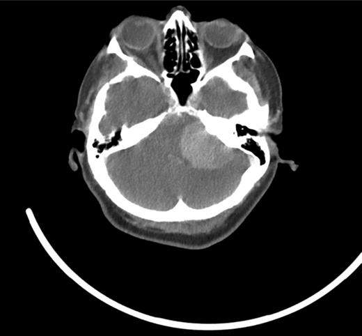 CT scan—large (4 × 3.5 cm) mass within the left posterior fossa.