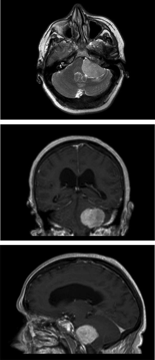 MRI head revealed posterior fossa meningioma.