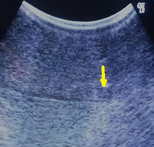 Hypoechoic 5-mm lesion at 2 cm depth (metachronous metastatic tumor from colorectal carcinoma) (arrow).