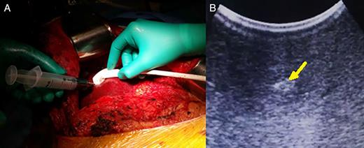(A) Methylene blue injection under ultrasonographic guidance and (B) easily identifiable methylene blue-injected lesion with hyper-echoic pattern (arrow).