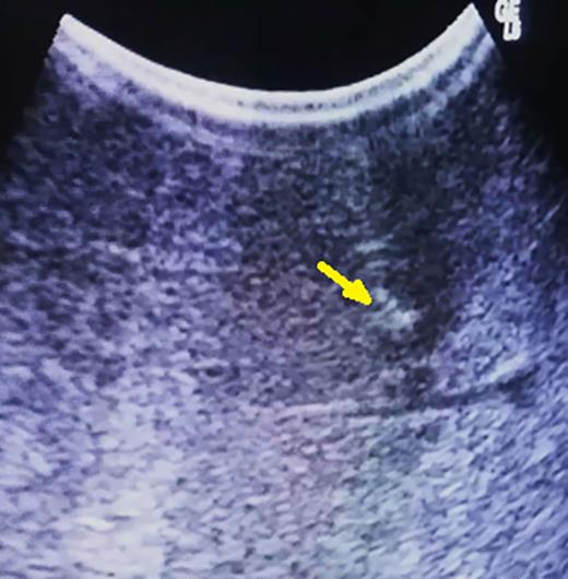 After parenchymal disruption, hyper-echoic lesion still clearly by ultrasonography (arrow).