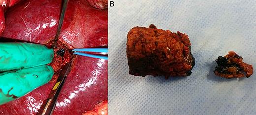 (A) Methylene blue-injected area containing the tumor within the parenchyma and (B) two specimens: the smaller one, that was displaced deeper within the parenchyma, containing the tumor.