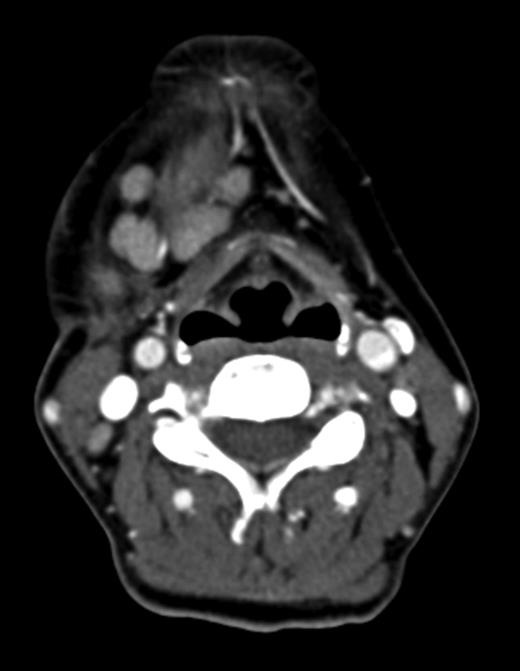 Axial CT neck (post contrast) showing enlarged right submandibular nodes.