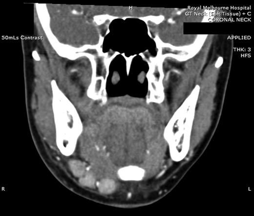 Coronal CT (post contrast) showing enlarged right submandibular nodes.