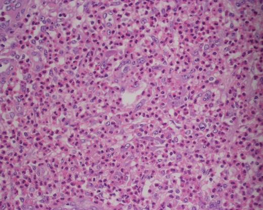 Photomicrograph of haematoxylin and eosin (H&E)-stained sections (×400) showing collection of eosinophils within the paracortex.