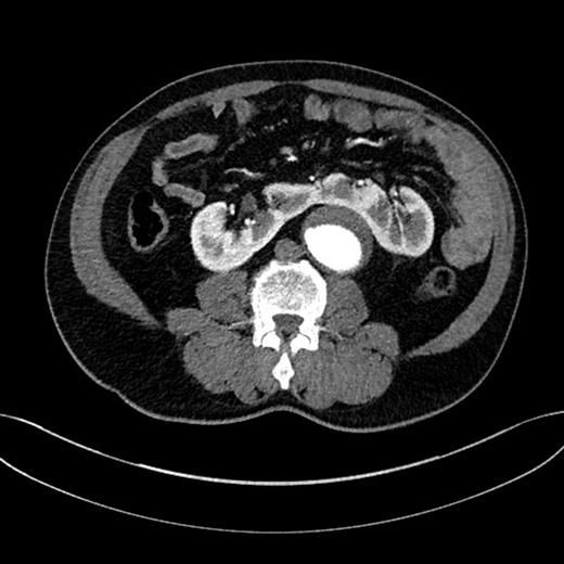 CTA demonstrated an AAA and a co-existent HSK.