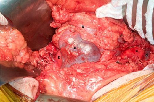 (a) HSK (the isthmus), (b) the distal segment of aneurysm close to the iliac bifurcation, (c) the aneurysm neck, (d) the left renal vein and (e) the left ureter.