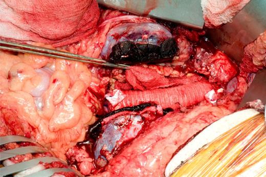 The divided renal isthmus and repaired aneurysm using a 20 mm Dacron.