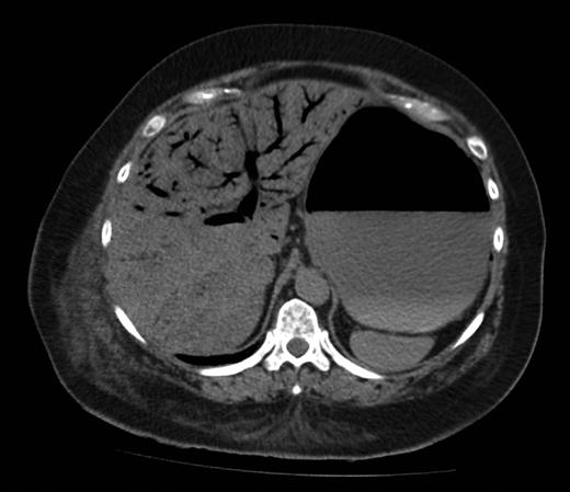 Axial image showing extensive hepatic PVG.