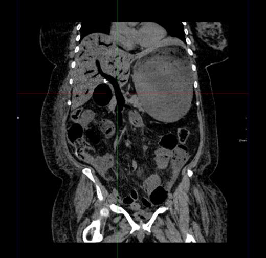 Coronal image showing air outlining the portal vein and superior mesenteric vein.