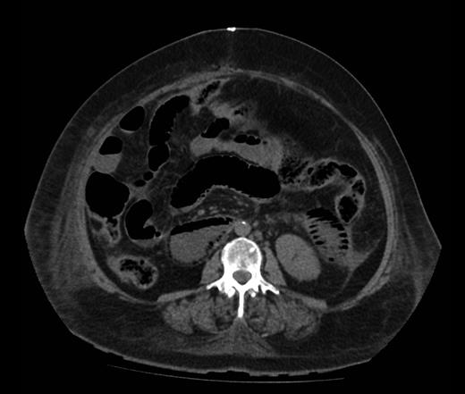 Axial image demonstrating intra-mural gas affecting both small and large bowels.