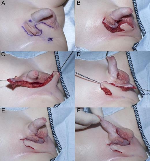 Rotation flap correction of ectopic scrotum: (A) marked flaps and perforator vessels, (B) raised flaps, (C and D) flaps rotated and (E and F) skin closure.