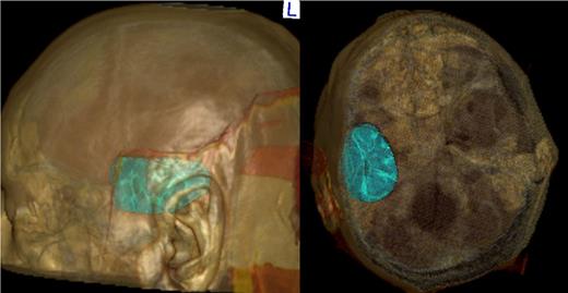 Osirix® CT reconstruction.