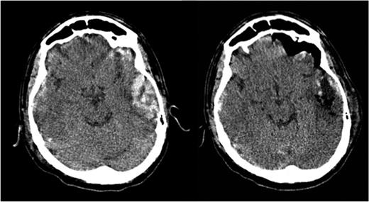 Comparison between pre- and postoperative CT scans.