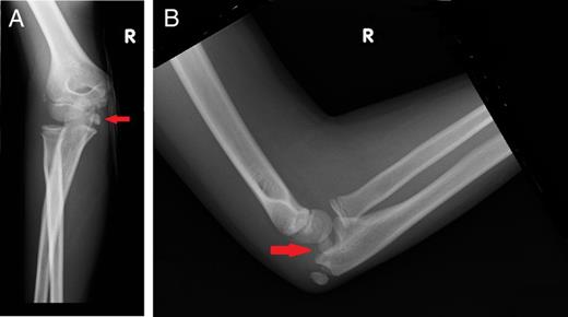 Plain radiographs of the injured right elbow: (A) anteroposterior view and (B) lateral view. Arrows highlight the avulsed medial epicondyle.
