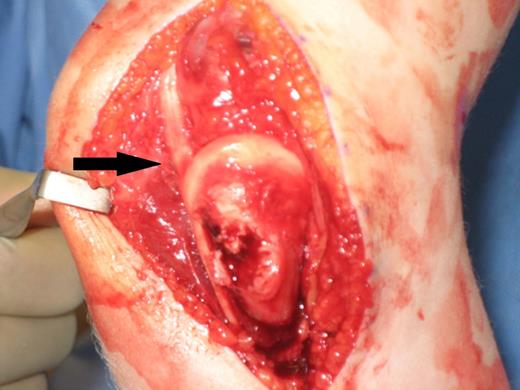 Intraoperative image showing the intra-articular entrapment of the ulnar nerve highlighted by the arrow.