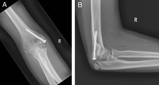 Plain radiographs showing the healed fracture of the right elbow at 5 months: (A) anteroposterior view and (B) lateral view.