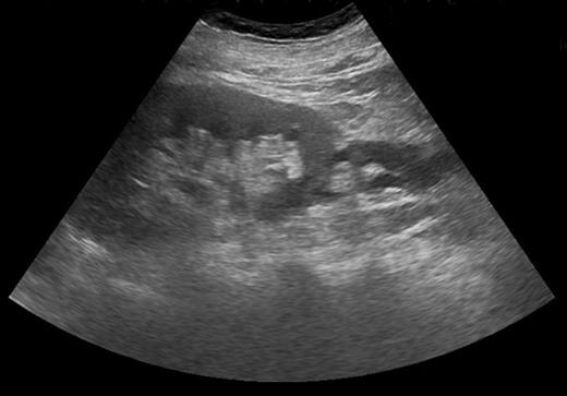 USS demonstrating shallow fluid collection around left kidney.