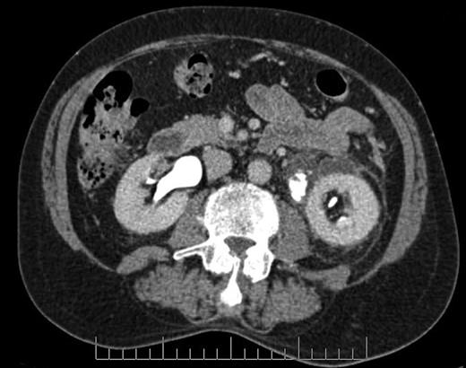 Axial section CT image demonstrating defect in left proximal ureter from which contrast is extravasating, with perinephric fluid collection and fat stranding.