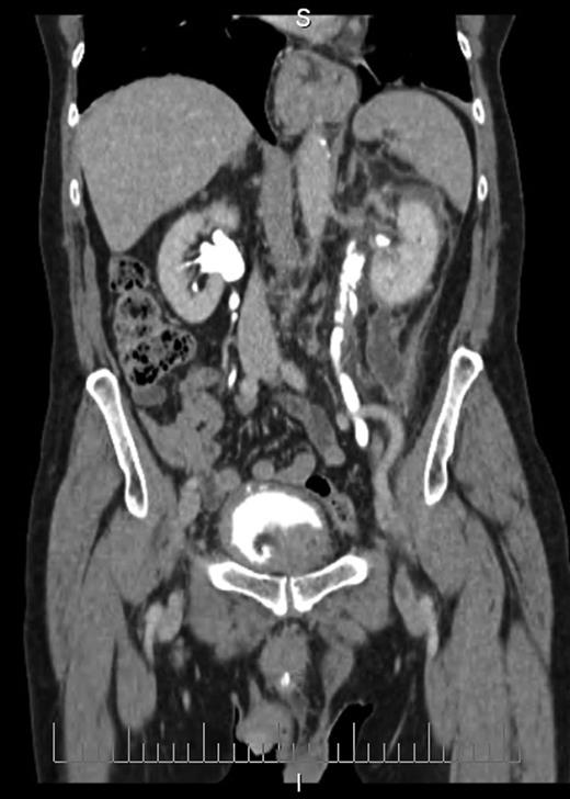 Coronal section CT image demonstrating fluid collection extending down left paracolic gutter. Also visible are massively enlarged prostate and urinary extravasation from left ureter.