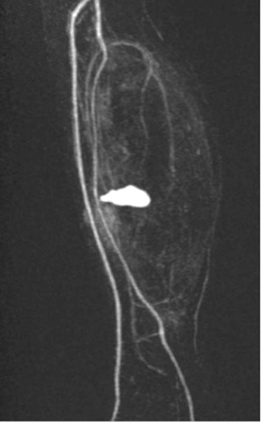 MRI images demonstrating the site, size and the origin of the PTA pseudoaneurysm.