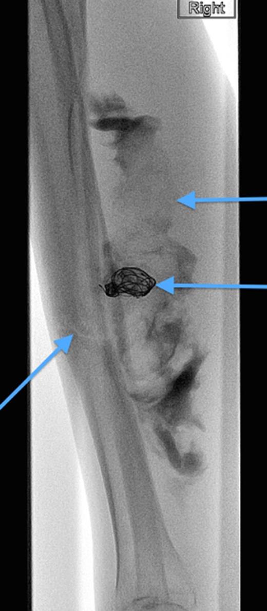 Angiographic image, demonstrating the site of the nonunion, coil insertion to the pseudoaneurysm and extravasated contrast.