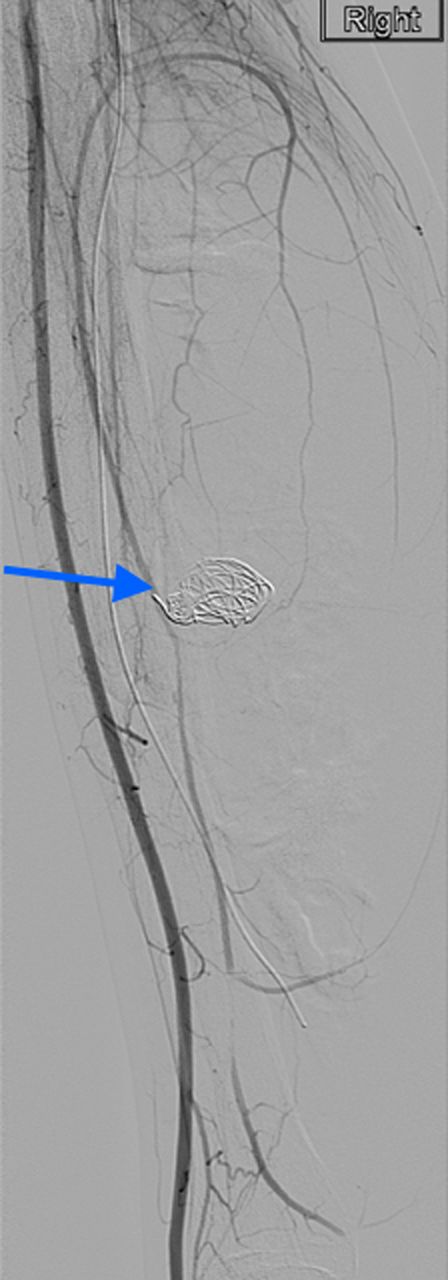 Complete resolution of the pseudoaneurysm and confirmed patent PTA.