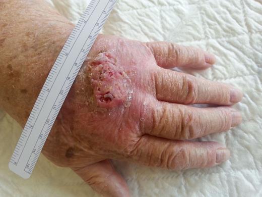 Clinical appearance of the keratoacanthoma located on the dorsum of the left hand.