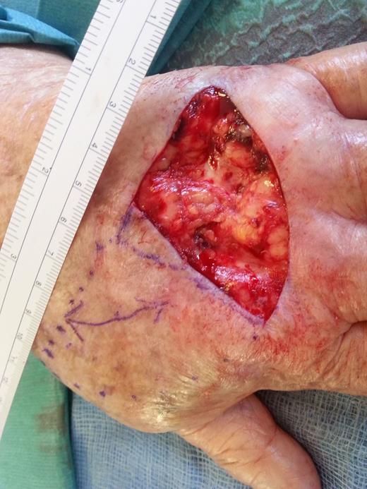 A triangulated defect following the local excision and the flap designed with a semicircular curve on the radial aspect.