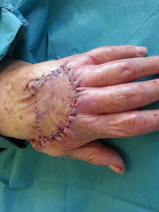 The flap rotated and sutured in position.