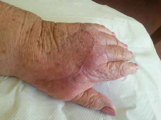 The end result of the flap in Figs 1–3.