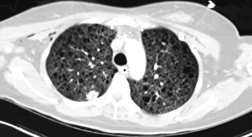 CT chest (axial slices in lung window) demonstrating innumerable cysts scattered throughout all lung fields without basal/apical predilection or cardiophrenic sparing.