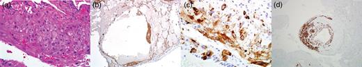 Histologic images from lung biopsy demonstrating perivascular leukocytic infiltrate (H&E 400×) (a), staining for smooth muscle actin (SMA 40×) (b), Hmb-45 (400×) (c) and desmin (100×) (d).