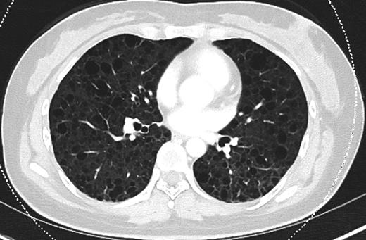 CT chest (axial slices in lung window) demonstrating interval resolution of pneumothoraces and persistent, diffuse numerous thin-walled pulmonary cysts without cardiophrenic sparing.