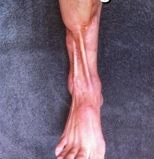 Right lower extremity pre-fat transfer.