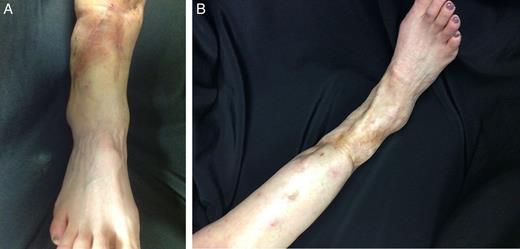 Right lower extremity post-fat transfer 3 sessions two-view.